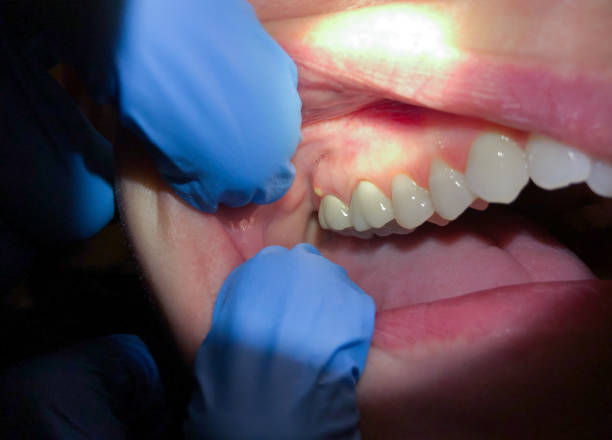 Best Emergency Root Canal Treatment in Middlebranch, OH